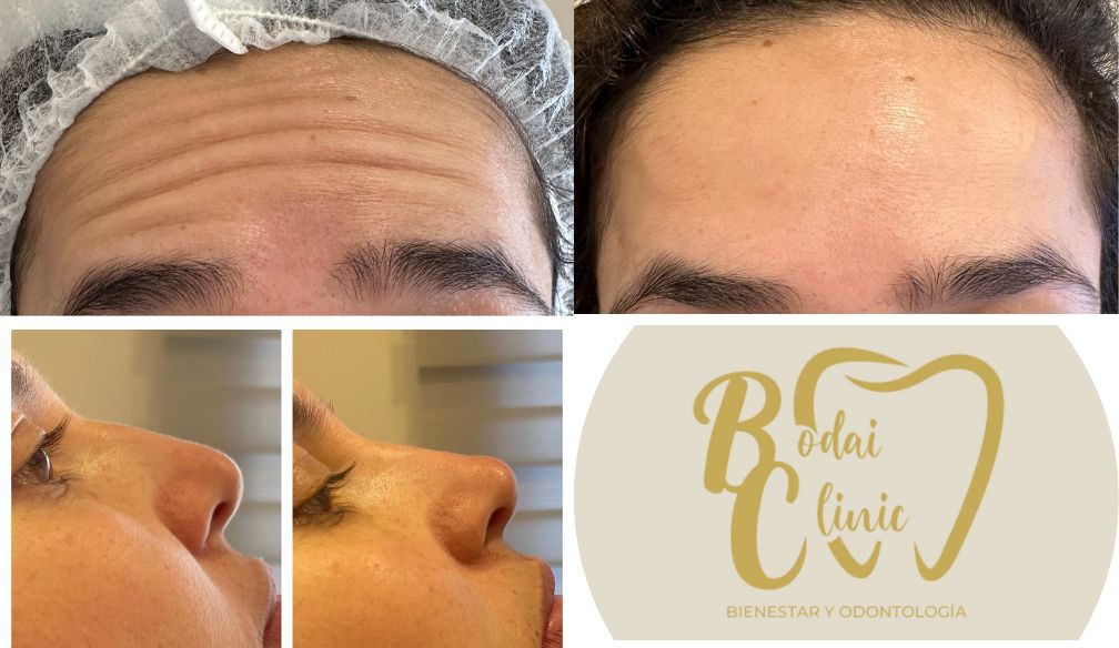 Belleza Natural en Bodai Clinic: Botox y Rinomodelación con la Dra. María Paz Zapata