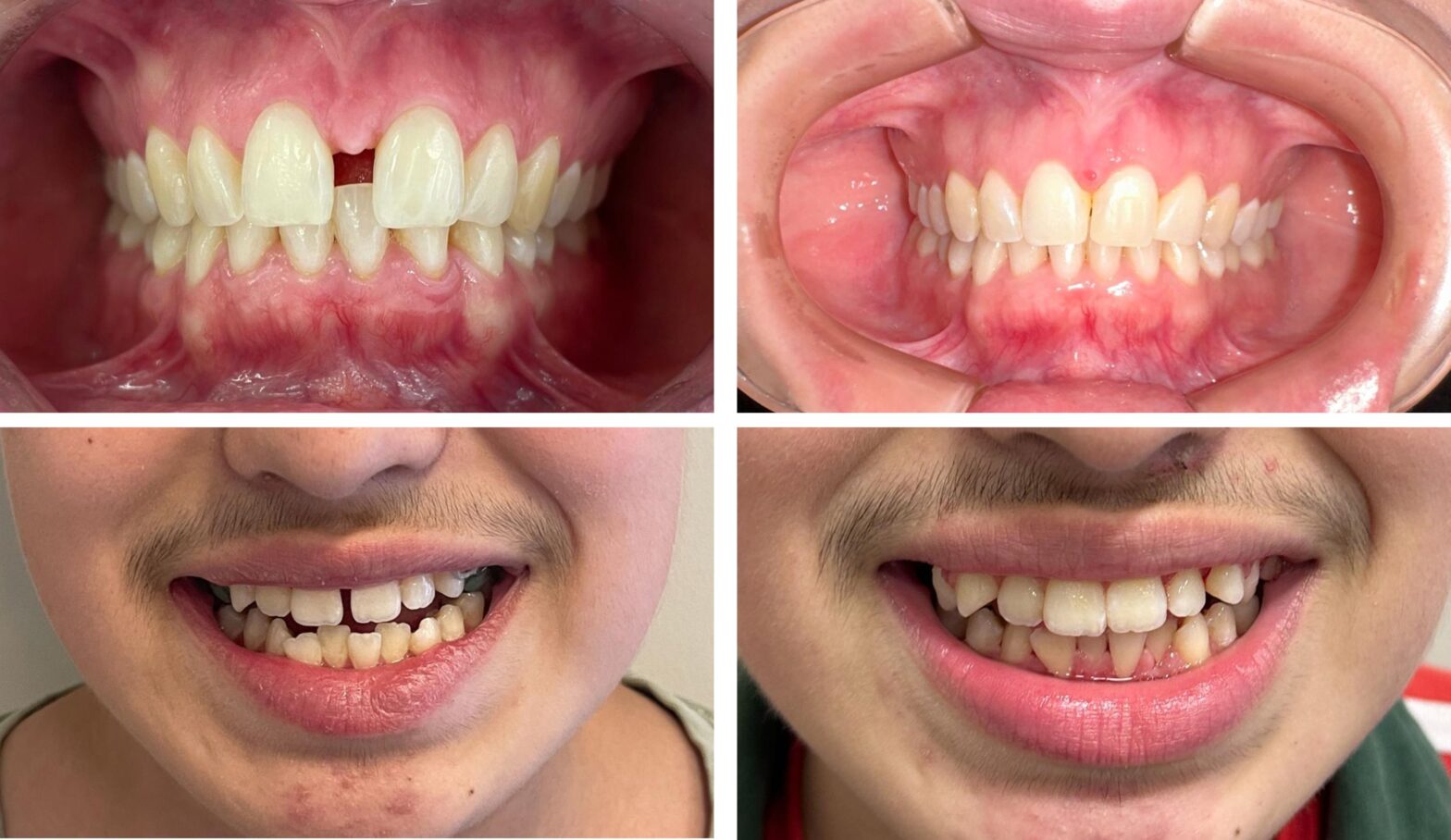 Éxito en Tratamientos de Ortodoncia en Bodai Clinic: La Dra. María Paz Zapata Transforma Sonrisas en Chillán
