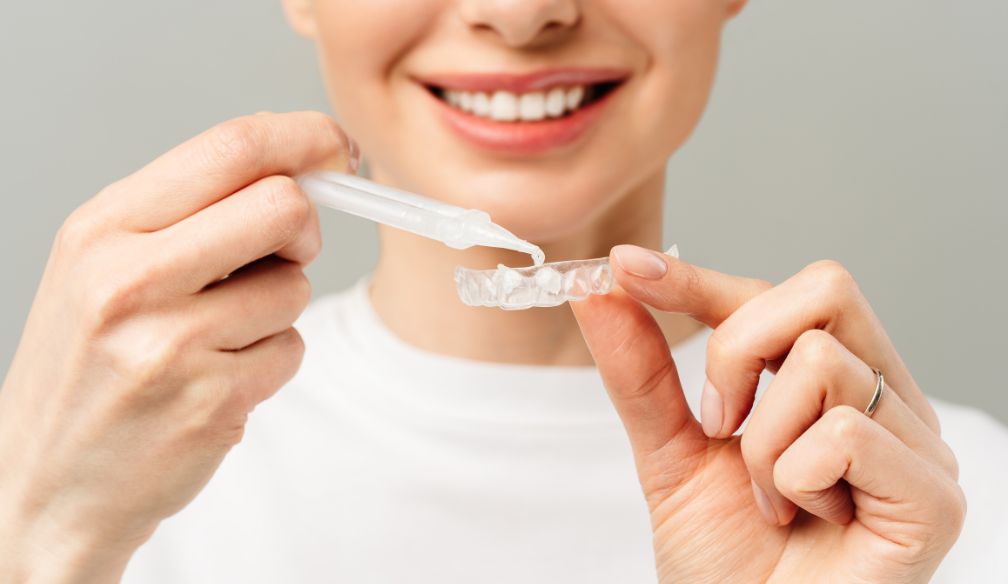 Blanqueamiento Casero Personalizado: La Solución Eficaz para una Sonrisa Radiante